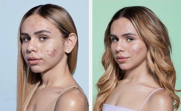 Linha Antiacne para Sallve — imagem 5